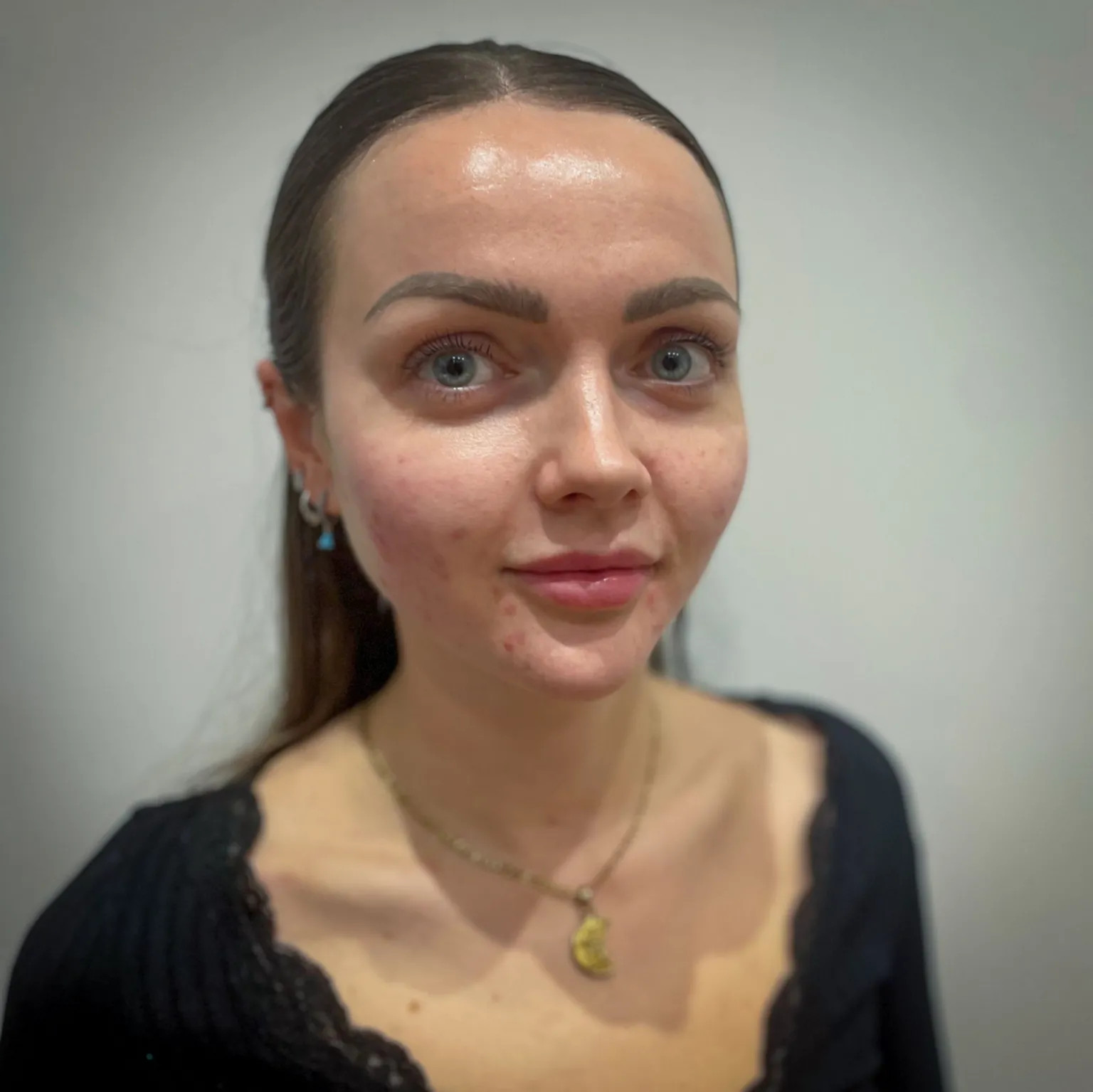 Fish DNA facials: The rise, risks, and reality of polynucleotide treatments