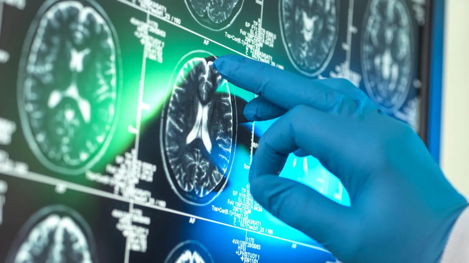 Alzheimer's drugs' benefits questioned amid scientific divide