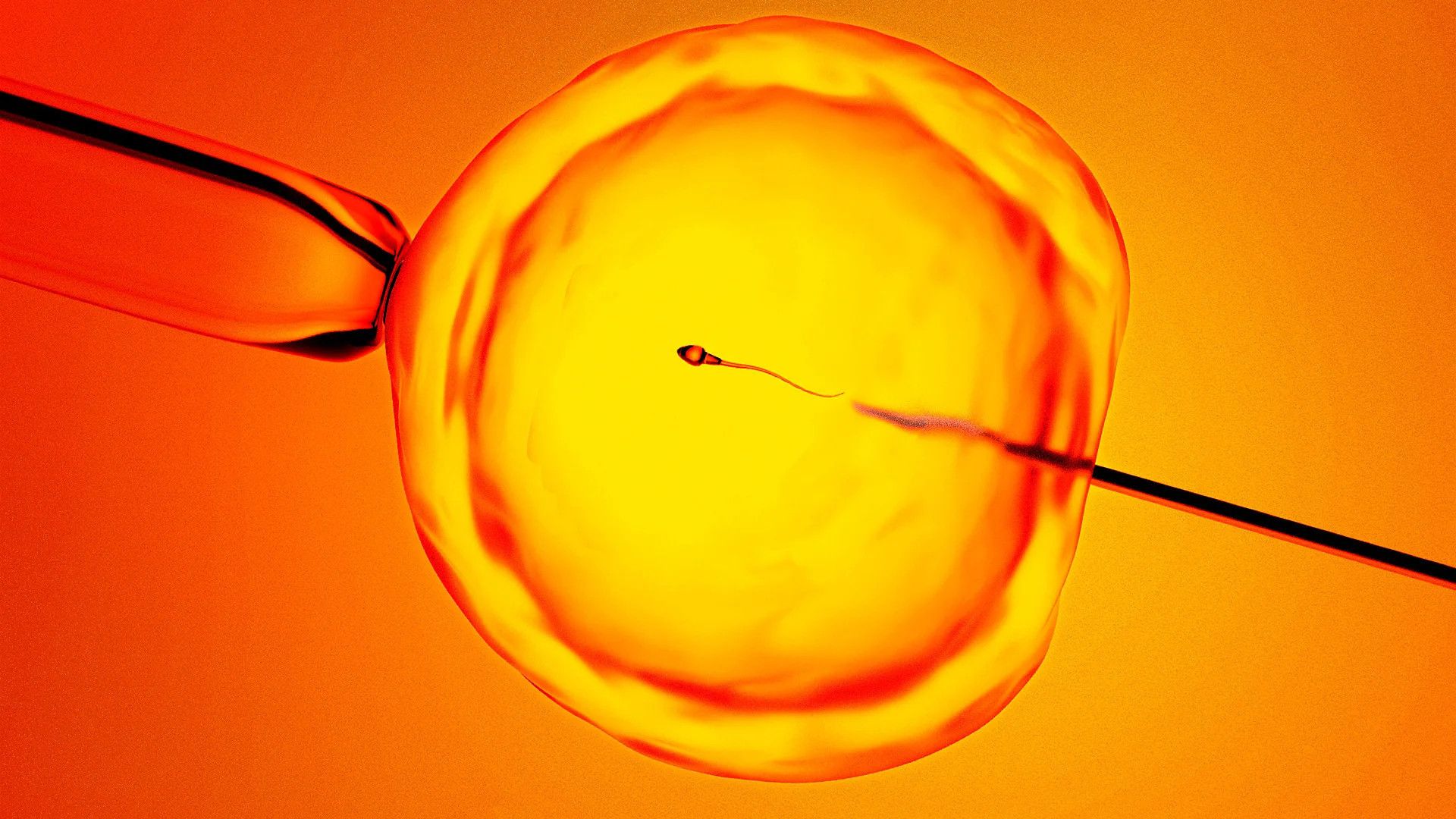 AI breakthrough locates hidden sperm in infertile men, offering new hope for parenthood