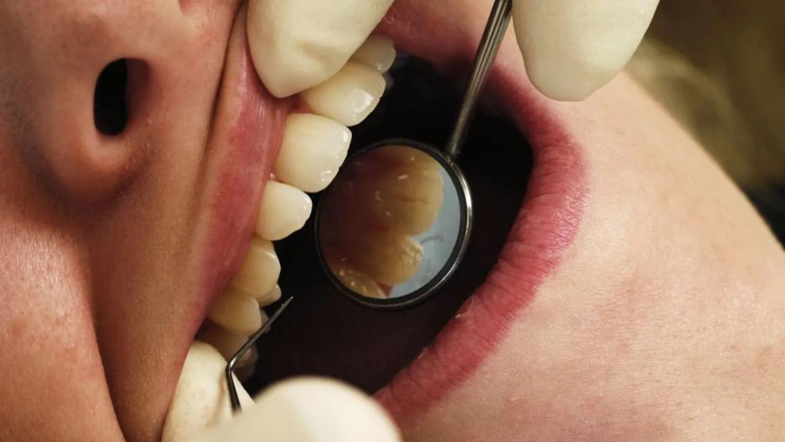 Australia warns thousands of dental patients over virus risk from poor hygiene