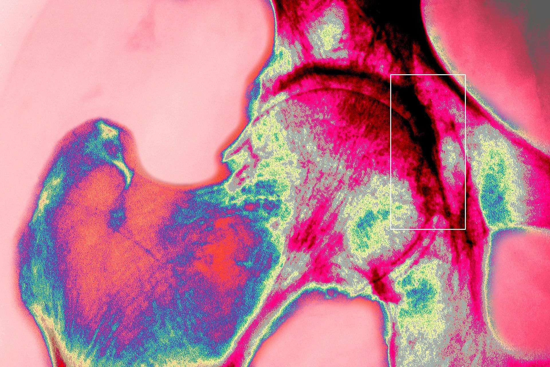 AI-designed metamaterials set to revolutionize bone implants and fracture healing